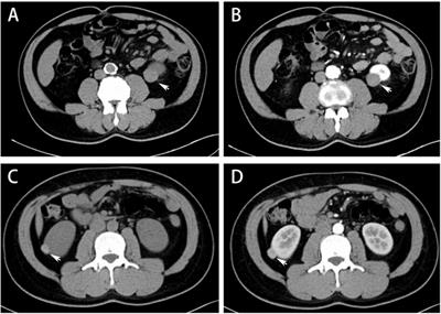 Papillary renal neoplasm with reverse polarity with a favorable prognosis: Two cases report and literature review